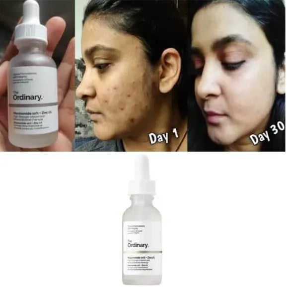 The Ordinary Niacinamide 10% + Zinc 1% Face Serum – Oil Control, Acne Treatment & Skin Brightening Serum for Clear Glowing Skin